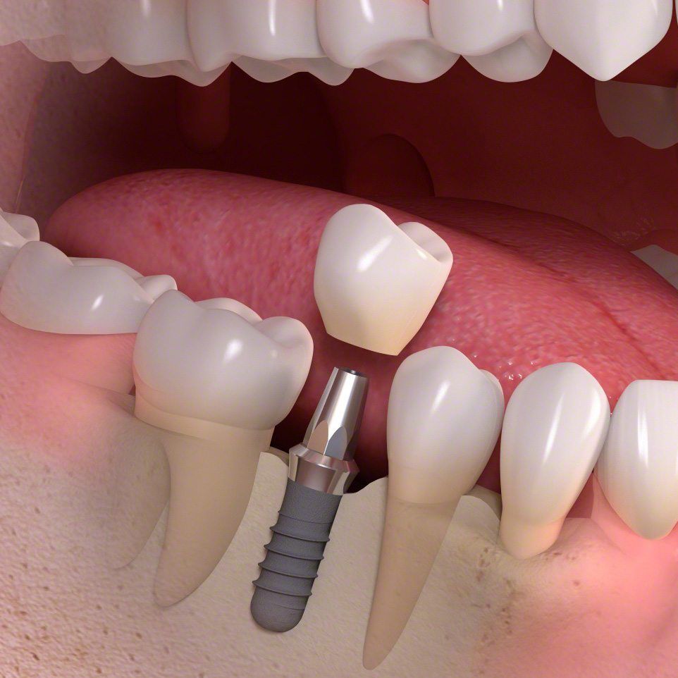 dental bridges vs implants