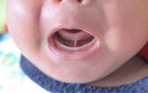 Newborn with Tongue-Tie Condition