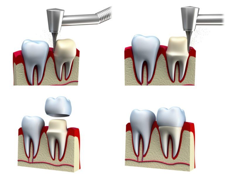 Dental crown installation process 3d illustration