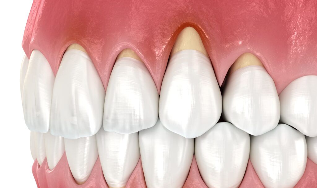 How to Recognize Early Signs of Gum Recession Cromwell Dentists